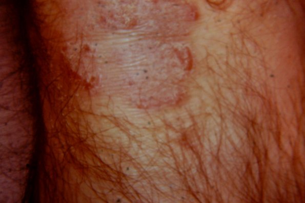 Psoriasis (64)