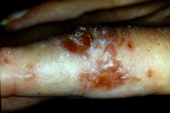 Pustular Psoriasis