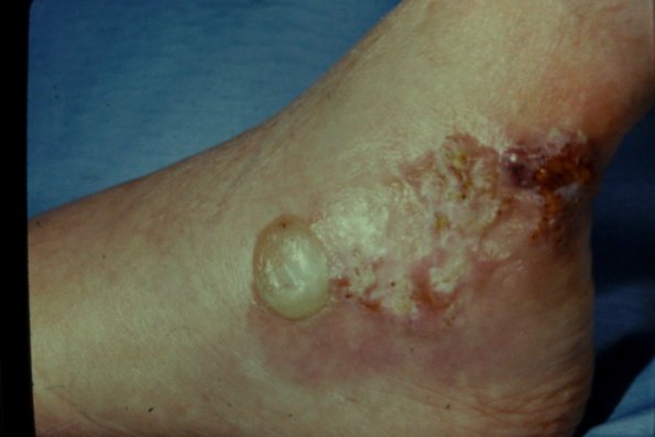 Bullous Pyoderma