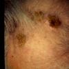 Lymphoma With Pyoderma (2)