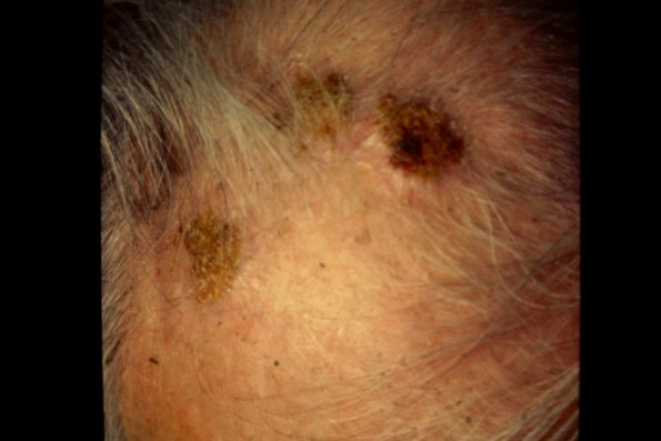 Lymphoma With Pyoderma (2)