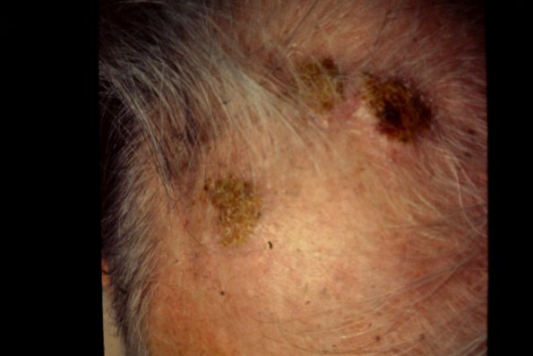 Lymphoma With Pyoderma