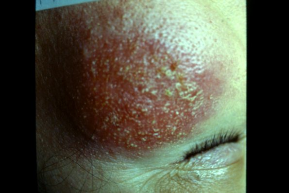 Pyoderma + Drug Erruption