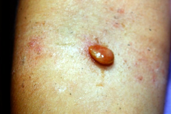 Pyogenic Granuloma (3)