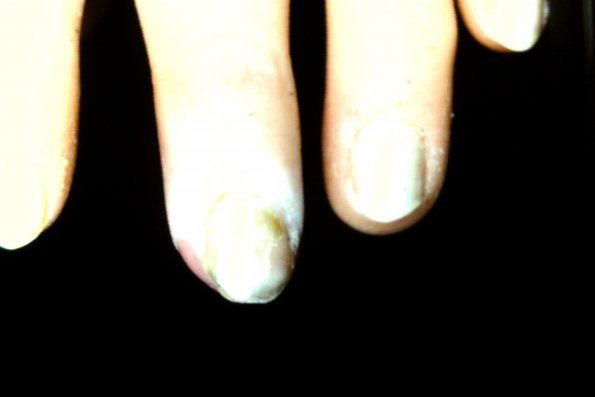 Raynauld's (2)