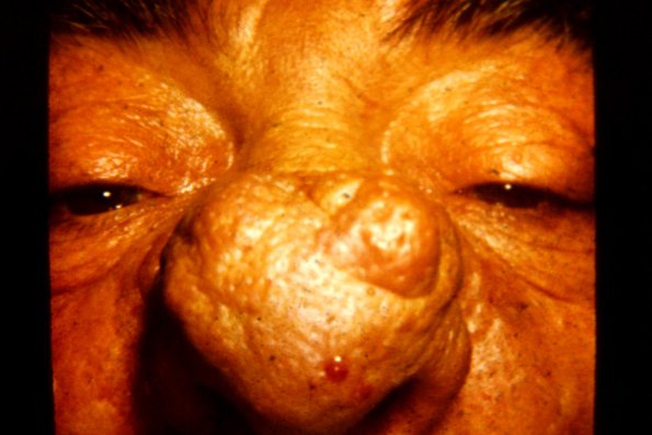 Rhinophyma (3)