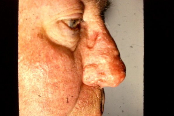 Rhinophyma (9)