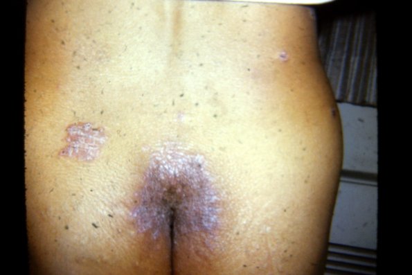 Psoriasiform Sarcoid