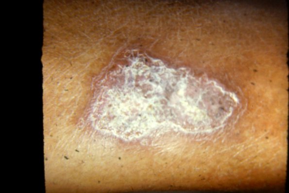 Sarcoid Psoriasiform