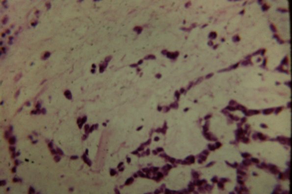 Squaroid Sarcoma (2)