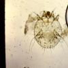 Accarus Scabies (2)