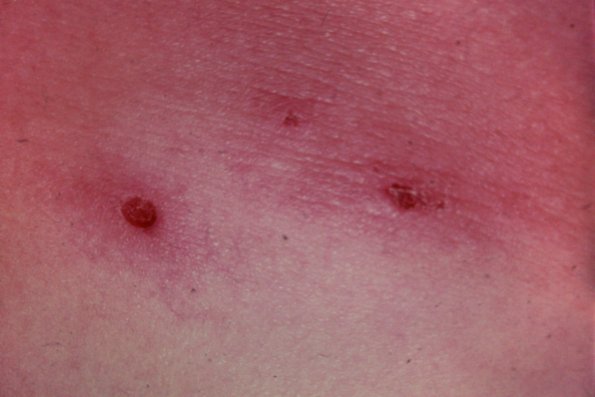 Scabies (2) | Scabies | Comprehensive Dermatology Photo Atlas | Wayne ...