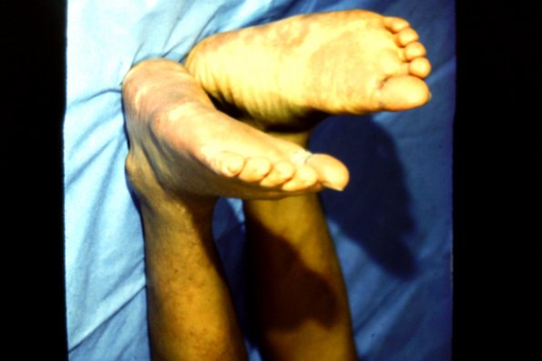 Vascular Malformation Scaring (2)