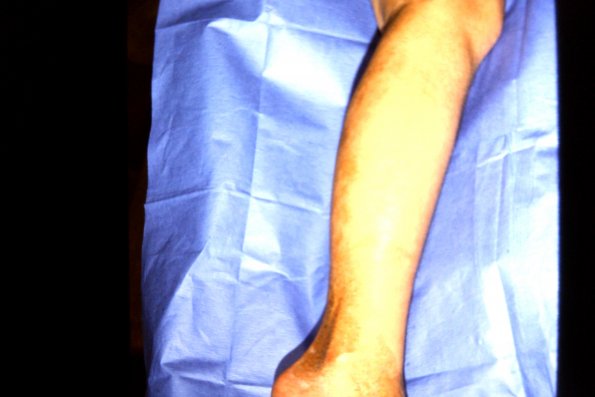 Linear Scleroderma Leg