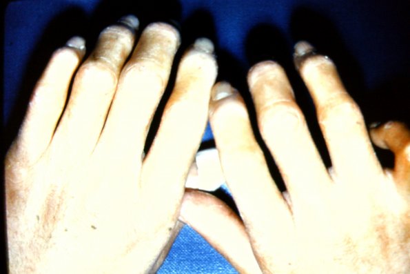 Scleroderma (18)