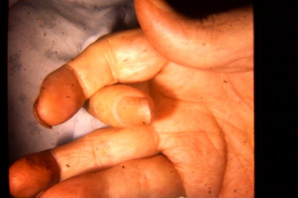 Scleroderma (27)