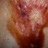 Scleroderma (35)