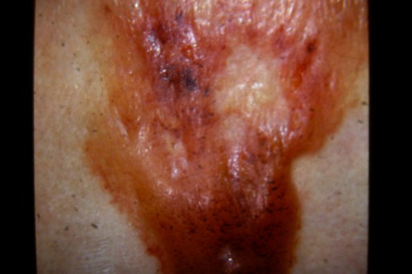 Scleroderma (35)