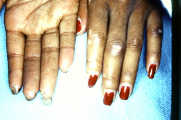 Scleroderma (45)