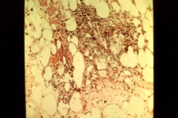 Scleroderma Neonatorum (5)