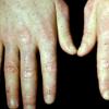 Sclerodermatomyositis (3)