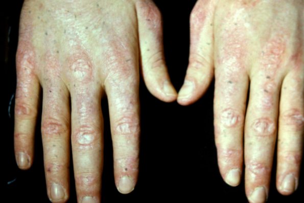 Sclerodermatomyositis (3)