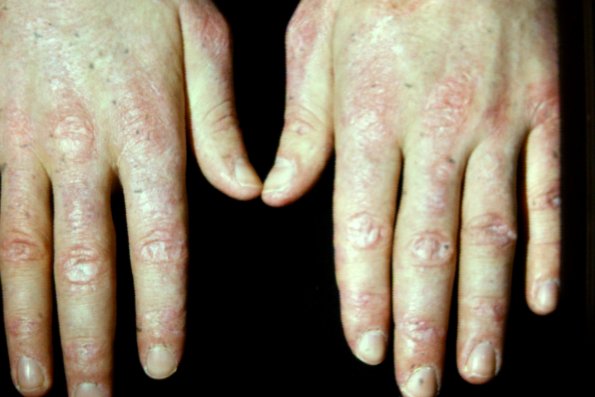 Sclerodermatomyositis