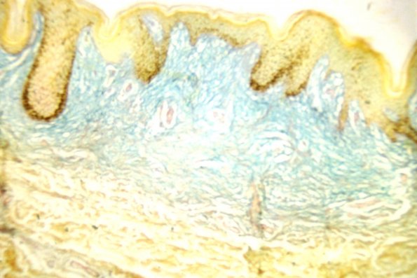 Scleromyxedema (16)