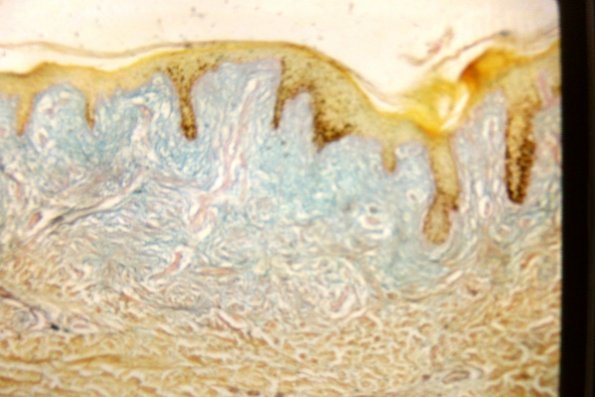 Scleromyxedema (35)