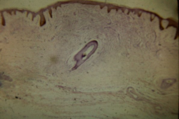 Scleromyxedema (39)