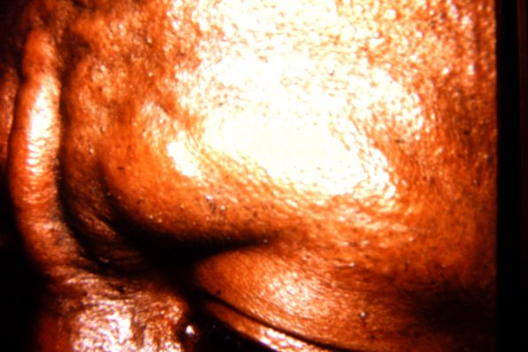 Scleromyxedema (5)