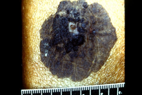 Seborrhaic Kyatosis