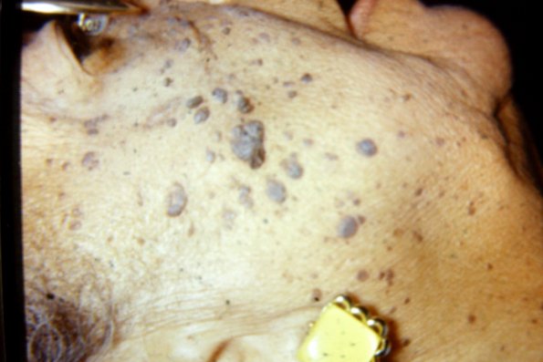 Seborrhic Keratosis (2)