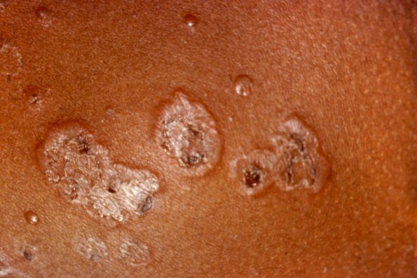 Subcorneal Pustular Dermatosis (2)