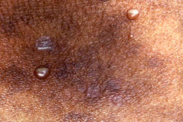 Subcorneal Pustular Dermatosis (9)