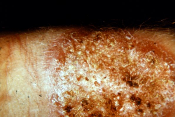 Sporotrichosis (20)