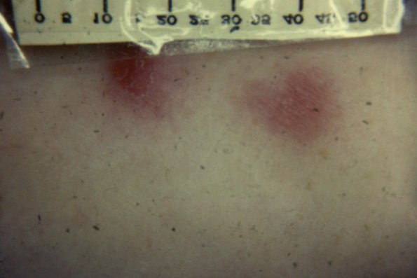 Sporotrichosis (24)