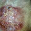 Sporotrichosis (27)