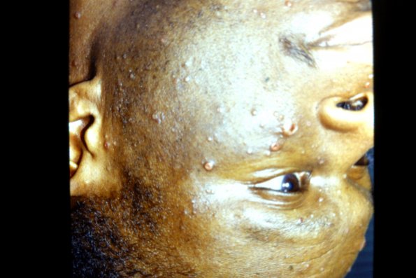 Sporotrichosis (4)