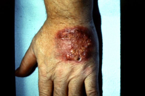 Sporotrichosis (5)