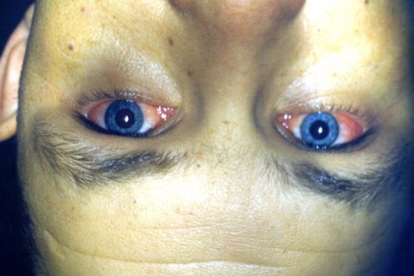 Behlet's Syndrome + Cenjuctivitis