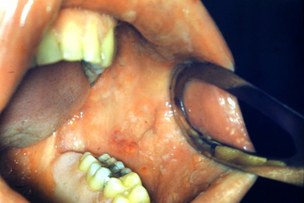 Behlet's Syndrome + Stomatitis (2)