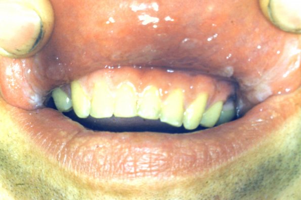 Behlet's Syndrome + Stomatitis