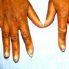 Raynauld's Syndrome