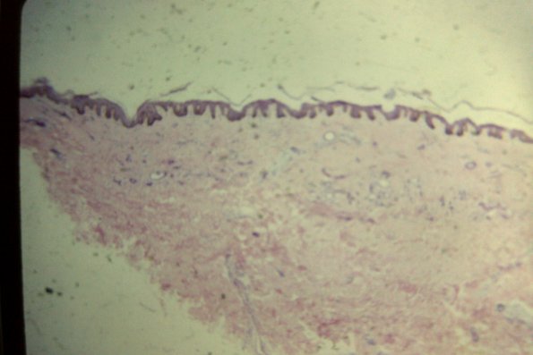 Syringoma (25)