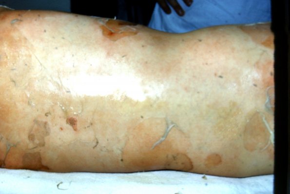 Toxic Epidermal Necrolysis (11)