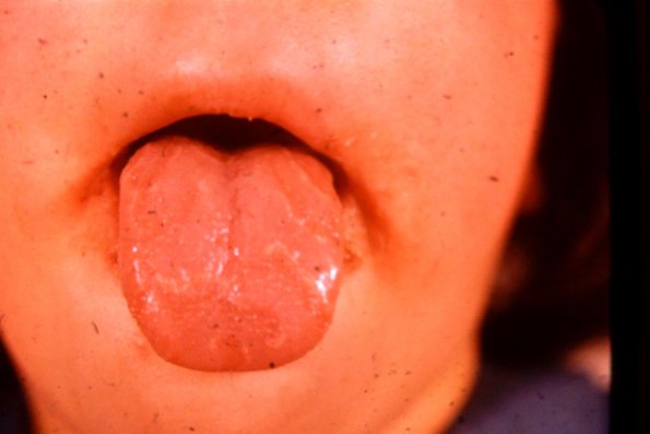 Geographic Tongue (2)