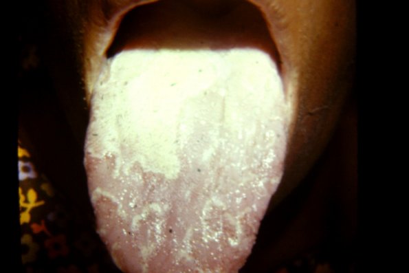 Geographic Tongue