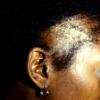 Traction Alopecia Vs Trichotillomania (2)