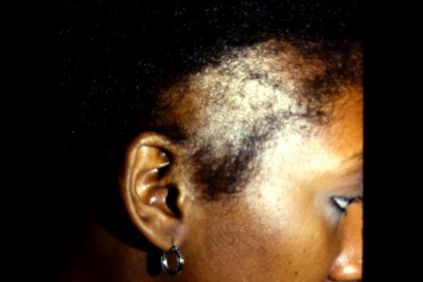 Traction Alopecia Vs Trichotillomania (2)